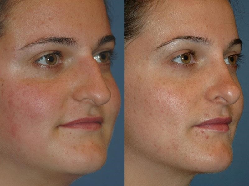 revision rhinoplasty expert los angeles