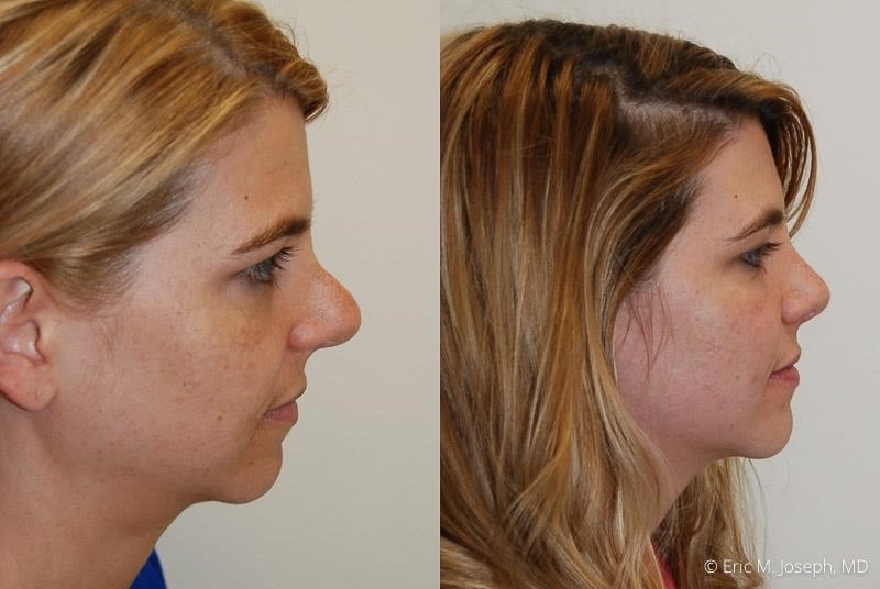 rhinoplasty expert nyc rhinoplasty expert nyc