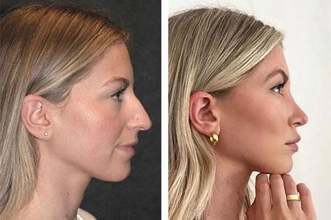revision rhinoplasty expert los angeles