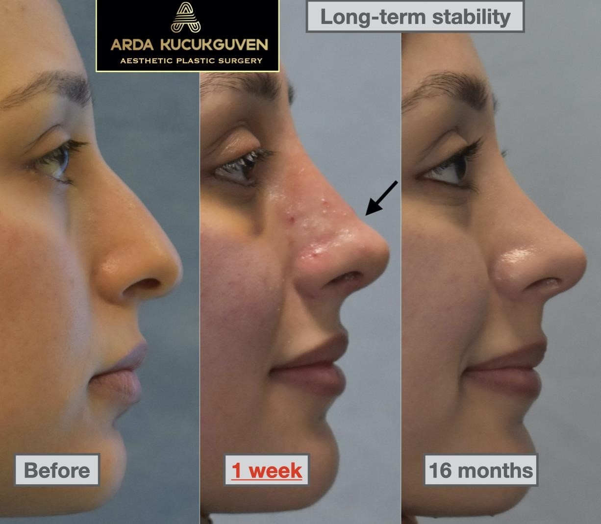rhinoplasty expert nyc rhinoplasty expert nyc