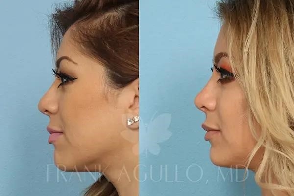 revision rhinoplasty expert los angeles