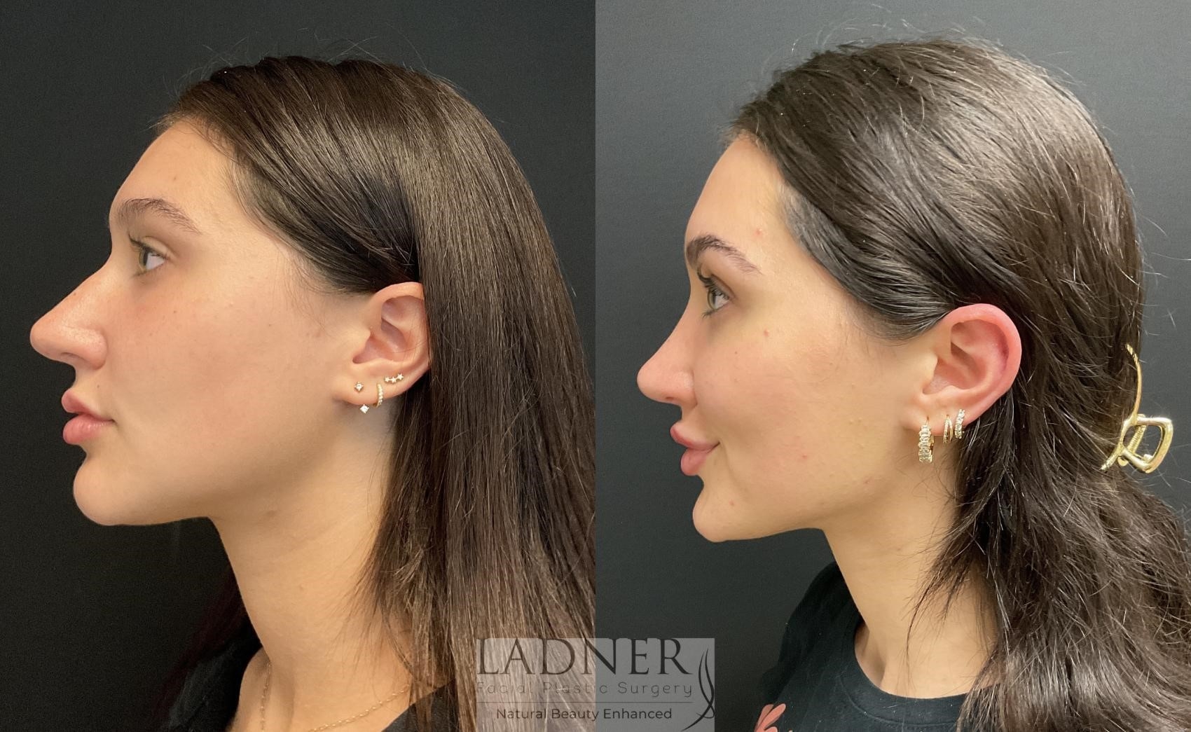 rhinoplasty expert nyc rhinoplasty expert nyc